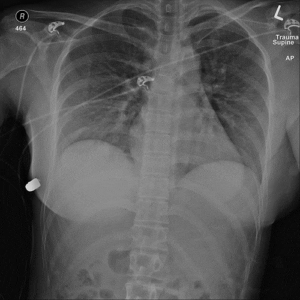 Doctors claim woman's breast implant saved her life when she got shot