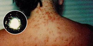 Sea lice invade the jersey shore