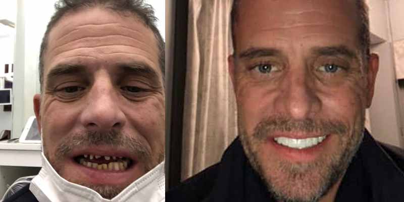 New York Post Hunter Biden Photos Claim to Show Before and After Dental Work to Fix "Meth Mouth"