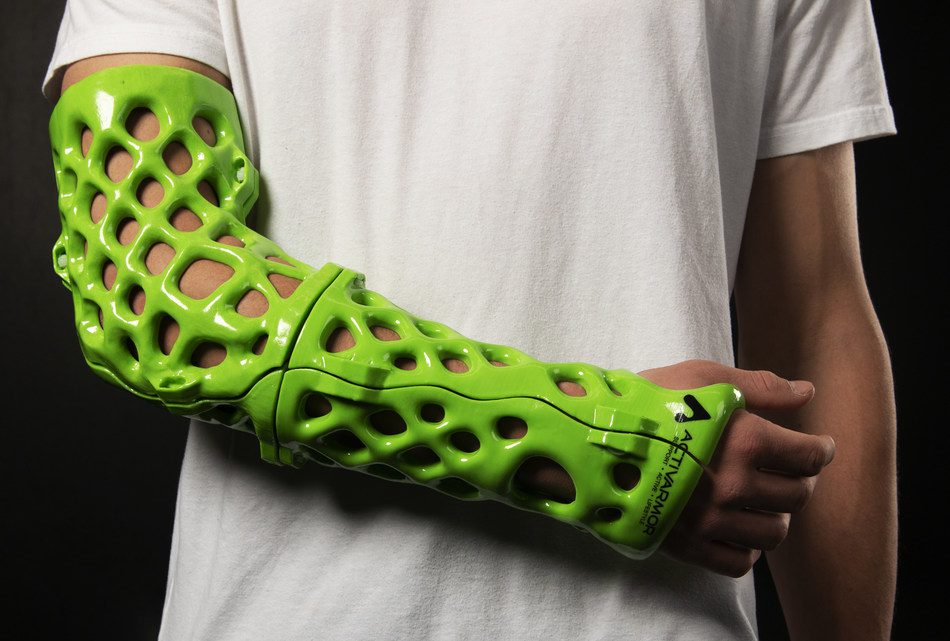 Are these new 3D casts the next big thing in sports medicine?