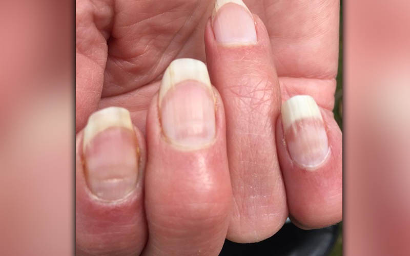 Researcher says "COVID nails" could be a sign that you had the virus