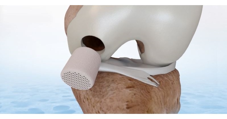 FDA approves CartiHeal's Implant for the Treatment of Cartilage and Osteochondral Defects
