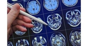 John theurer cancer center treats first patient in u. S. With investigational new treatment for brain cancer