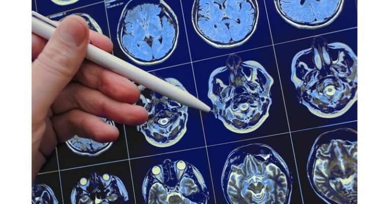 John theurer cancer center treats first patient in u. S. With investigational new treatment for brain cancer - photo licensed by shore news network.