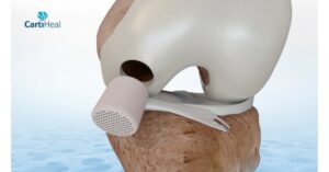 Peregrine ventures realizes usd 500 million exit from cartiheal following fda approval of implant for treatment of cartilage and osteochondral defects usa - english usa - english
