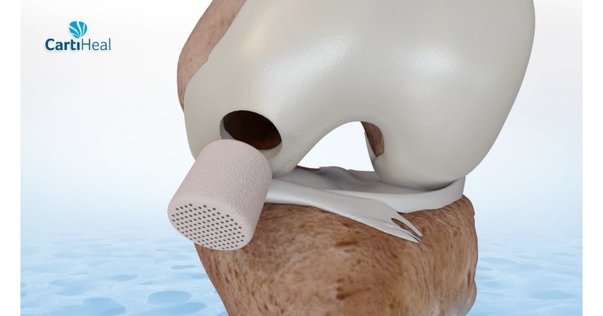 PEREGRINE VENTURES REALIZES USD 500 MILLION EXIT FROM CARTIHEAL FOLLOWING FDA APPROVAL OF IMPLANT FOR TREATMENT OF CARTILAGE AND OSTEOCHONDRAL DEFECTS USA - English USA - English