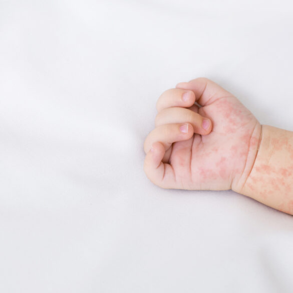 Dc health officials investigate potential measles exposures - photo licensed by shore news network.