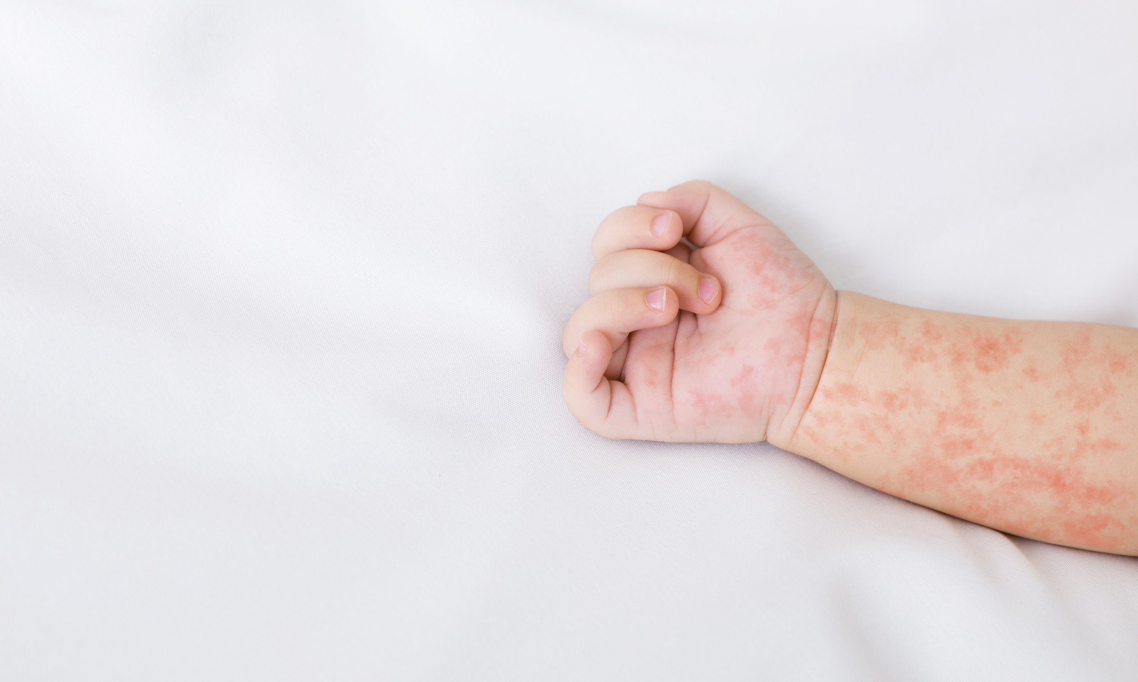 DC Health Officials Investigate Potential Measles Exposures