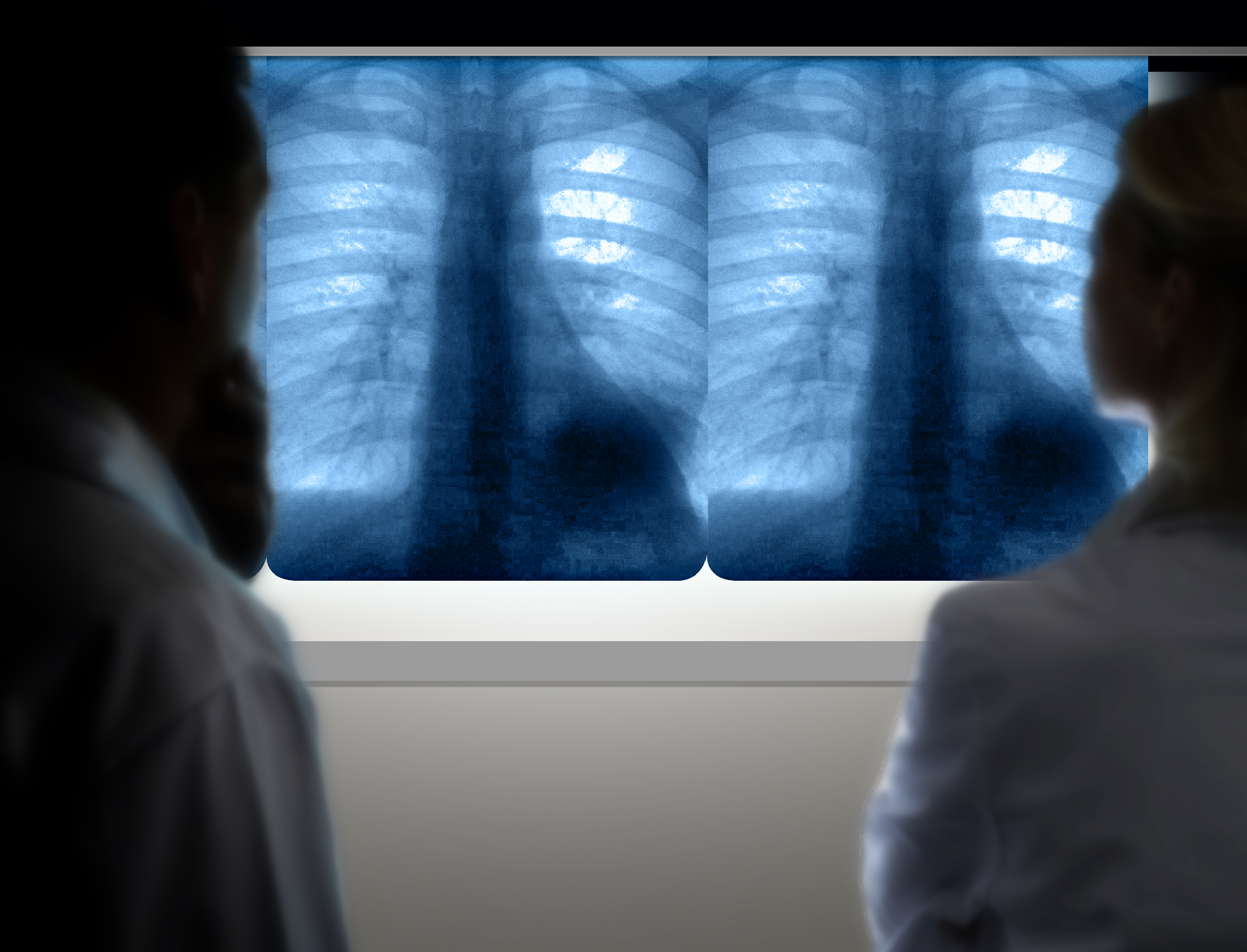 Lung X-Ray