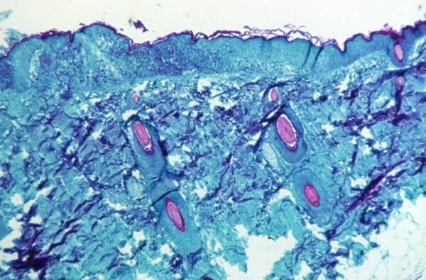 Who calls emergency meeting as monkeypox cases top 100 in europe
