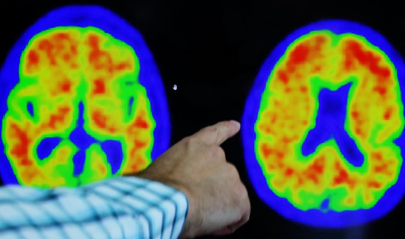 Lilly drug slows Alzheimer's by 35%, bolstering treatment approach