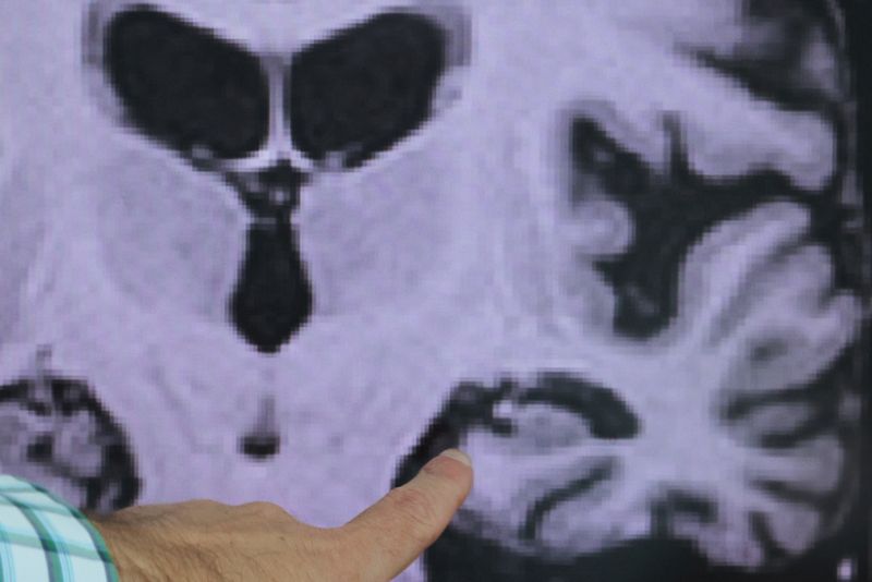 Experimental drug works best for Alzheimer's patients treated as early as possible